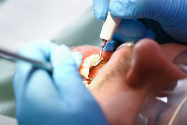 Best Emergency Tooth Extraction in Marble Hill, MO