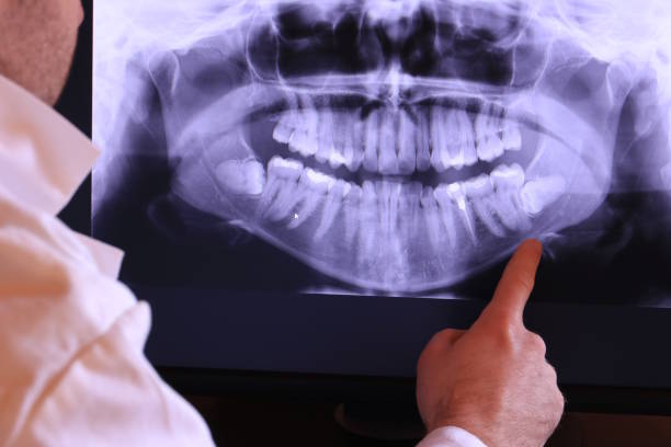 Best Emergency Tooth Extraction in Marble Hill, MO
